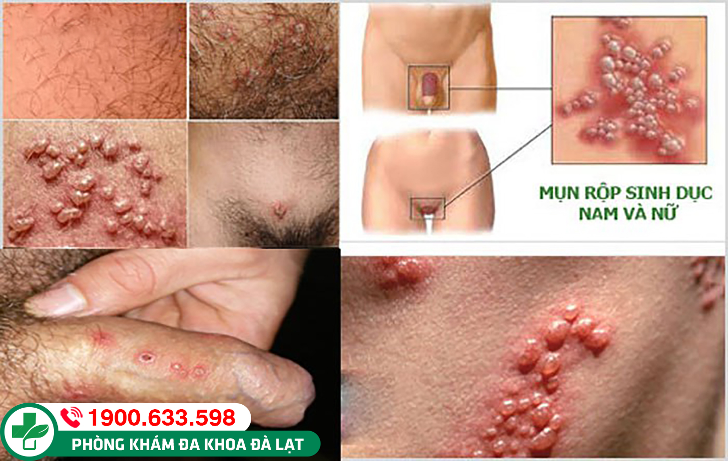 Mụn mủ ở bộ phận sinh dục nam & nữ giới là bệnh gì? Cách điều trị bệnh 